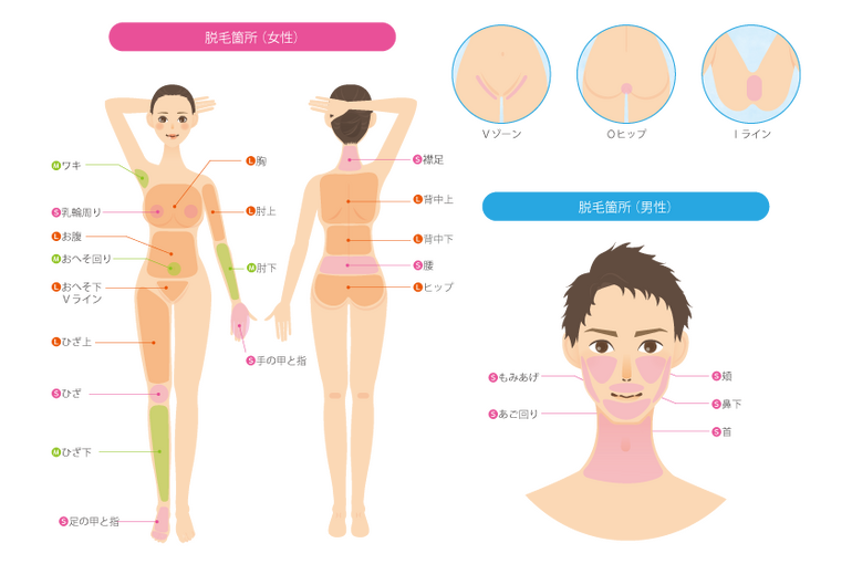 脱毛部位1